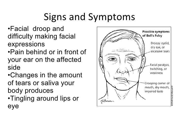 Facial paralysis symptoms Erotic 1920 ladies